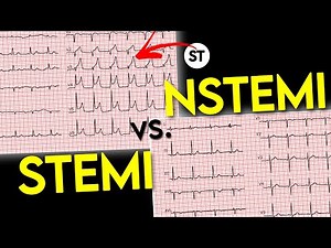ECG interpretation || STEMI vs NSTEMI || ECG of Myocardial Infraction • Daily Cardiology