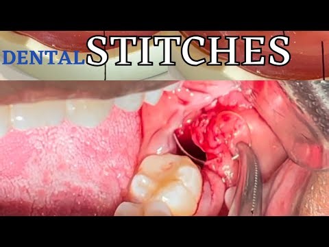 Compilation of Dental Stitches or Dental Sutures