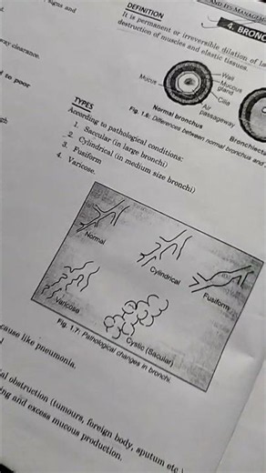 Bronchiectasis Explained in Easy Language 🫁