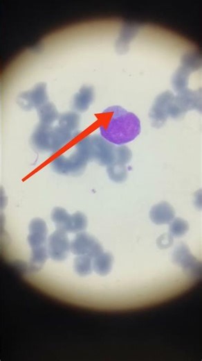 Auer Rods in AML Leukemia under microscope