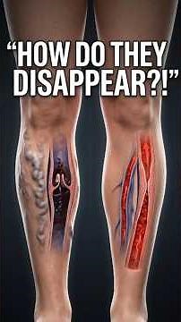 How Varicose Veins Are Treated — What Doctors Actually Do! 🦵 #varicoseveins #anatomy