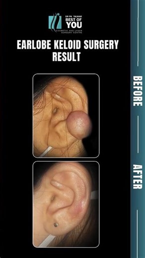 Earlobe Keloid Removal Surgery | Before & After Results by Dr.P.K Talwar, Cosmetic Surgeon in India