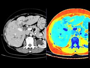 Philips IQon Spectral CT