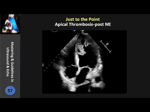 Apical Thrombosis-post MI