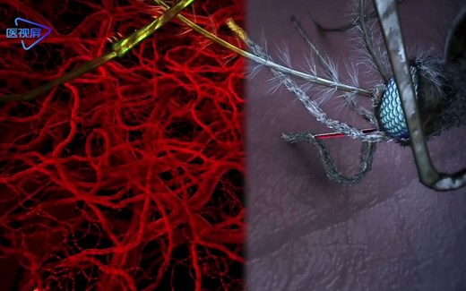 【医学3D】：疟疾：寄生虫传染的无国界传染病