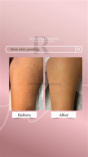Dra Fernanda Noyma | Have you heard of keratosis pilaris? Those red, rough bumps that often appear on the arms, thighs, glutes, or back, leaving the skin with... | Instagram