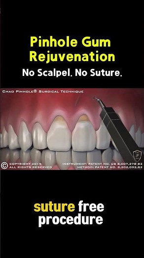 What Happens When Gums Pull Away — and How Pinhole® Fixes It #gumrecession