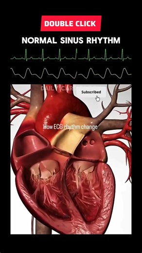 ECG Rhythm Changes Quick #ECG Guide #shortsfeed #guide#medicalshorts#clinicalskills #ecgchanges