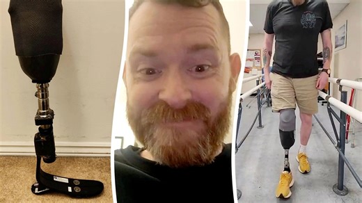 Man facing £35k bill for prosthetic leg builds one from Amazon for £100