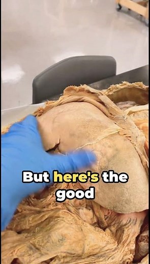 Liver Fluke Facts What Everyone Should Know