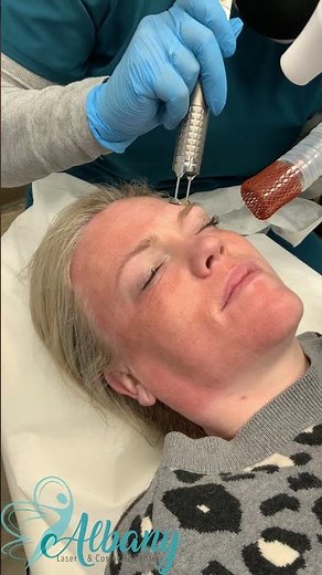 Fotona Fractional ablative laser and Fotona smooth