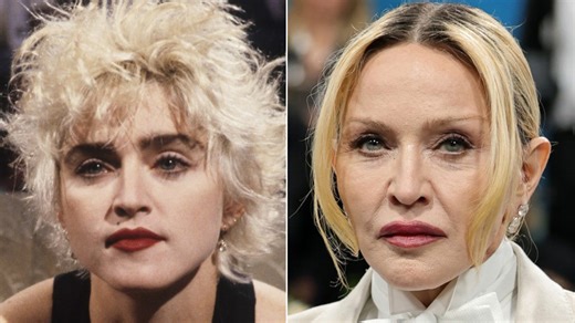 Before and after pics of Madonna make her dramatic plastic surgery undeniable