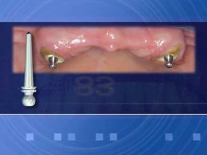 Rhein83 Root Retained Overdentures