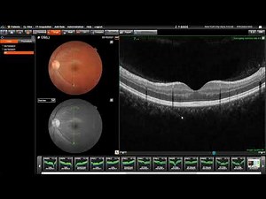 Topcon Maestro2: Retina Specific Scan