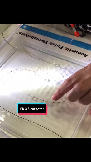 EKOS Catheter: Revolutionizing Clot Treatment
