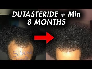 Hair Loss Recovery in 1 Year: Diffuse Hair Recovery
