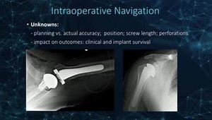 GPS Shoulder Navigation and Planning: My Surgical Experience, Clinical Results and Future Applications (3 of 4)