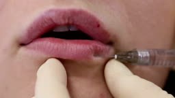 The Plastic Surgeon - Lips Augmentation