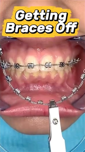 Getting Braces Off! Quick and painless ✨ #orthodontist #braces #bracesoff