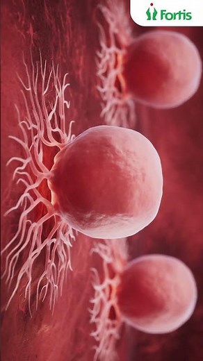 Ovarian Cancer: Why Early Detection Matters | Dr. Siddharth Shanker Sood