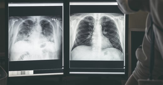 Los 10 síntomas tempranos del cáncer de pulmón que pueden pasar desapercibidos