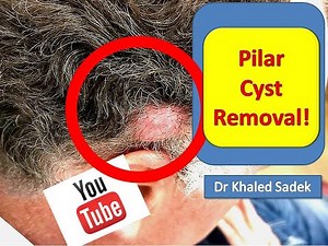 Large Pilar Cyst Removal. LipomaCyst.com Dr Khaled Sadek