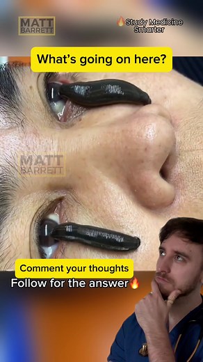 Understanding Leech Therapy in Modern Medicine
