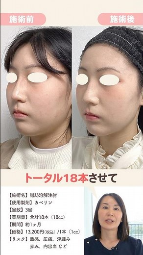 [Face Slimming] Get a smaller face with fat-dissolving injections! #SmallFace #MedicalDiet #AzClinic