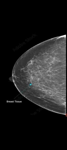 Mammography of breast Invasive Ductal Carcinoma@#@Awerenes of All@#@BI-RADS-5 Score@#@Breast disease