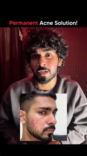 Yashveer Rohilla on Instagram: "Isotretinoin The Game Changer for Acne 🔥 If you’ve been fighting acne for years and nothing seems to work this medicine can literally change your skin and your confidence. ⸻ 🔹 What Is It? • Isotretinoin (also known as Accutane) is a powerful Vitamin A derivative. • It works from the root controlling oil glands, reducing acne-causing bacteria, and preventing clogged pores. ⸻ 💥 Benefits: ✅ Shrinks oil glands → less oil = fewer breakouts ✅ Prevents new acne format