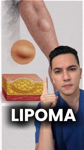 Lipoma: un tumor de grasa debajo de la pie. #dermatologia #dermatologo #dermatologowilliamguerrero #doctorwilliamguerrerodermatologo #drwilliamguerrerodermatologo