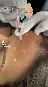 🎯Purpose: reduce fine lines around eyes and forehead 🤓How it works: Botulinum toxin relaxes muscle 🙌Results: Visible within 5 days, maximum effect by 2 weeks ✏️Note: Individual results may vary 😴Anesthesia: None Required ⏰Time it takes: 5 to 10 mins 👍Lasts: 4-6 months 💣 Caution: To be performed by experienced injector ☎️ Contact us : 014589035, 4597074 | Nepal Skin Care Centre