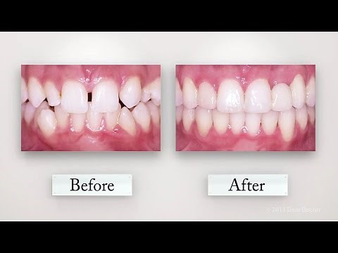 Clear Orthodontic Aligners