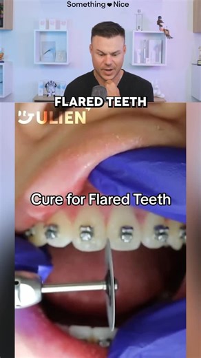 TheBentist on Instagram: "How Dentist Fox FLARED Teeth! 😮🦷 #braces #teeth #dentist"