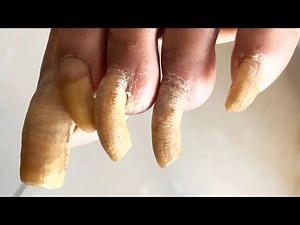 Extra Long Toenails, 1 Year Without Trimming【Pedicure Master Lin Jun】