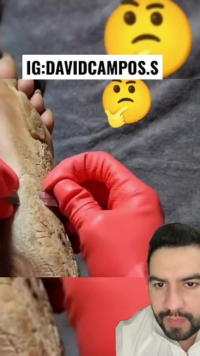 Tratamiento de la Hiperqueratosis Plantar: Guía Completa
