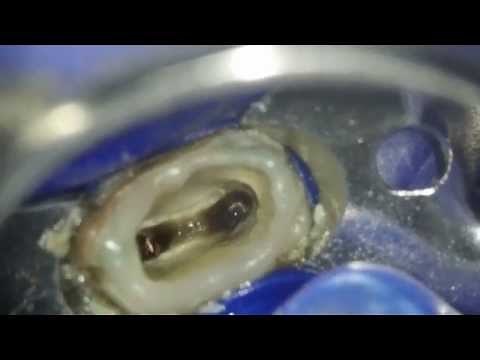 根の治療の準備 メタルコア除去