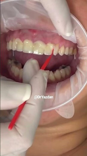 Porcelain veneer process | porcelain veneer before and after | porcelain crowns | Dr. Yazdan