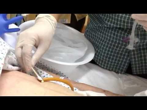 How to reinsert a PEG (feeding) tube by Dr. Dy
