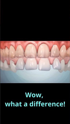How Does Invisalign Make Teeth Straight?