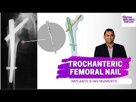 Trochanteric Femoral Nail | TFN | Implants And Instruments