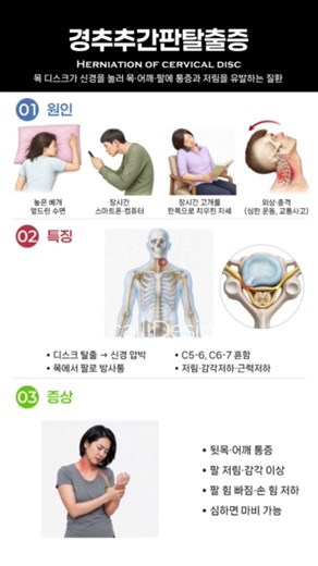 경추추간판탈출증 설명 세로 디자인