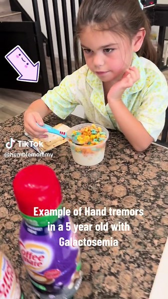 Galactosemia symptoms you might miss. #raredisease #advocacy #galactosemia #handtremors #pavethewayfda #medicalschool #medstudent #doctorsoftiktok #occupstionaltherapist #fda #genetics #geneticdisorder #genes