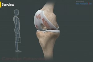 Cartilage Restoration