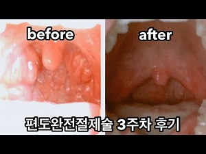 편도절제술 후기 (tonsillectomy review)