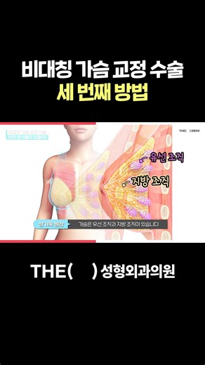 Correcting Asymmetrical Breasts with Glandular Repositioning | THE Plastic Surgery #GlandularRepo...
