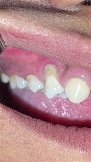Nepalidentist | 🦷⚠️ Localized Gum Recession Due to Calculus When plaque is not cleaned properly, it hardens into calculus (tartar). These deposits... | Instagram