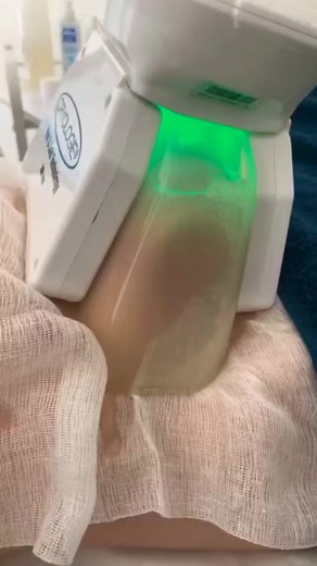 Cryolipolyse لإزالة الدهون وشد الترهولات | Centre d'esthétique Mila