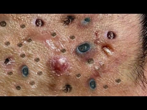 Blackhead Removal With Sac Dep Spa @100074764