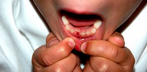 Curious Kids: My tooth fell out. Why is it so spiky on the bottom?